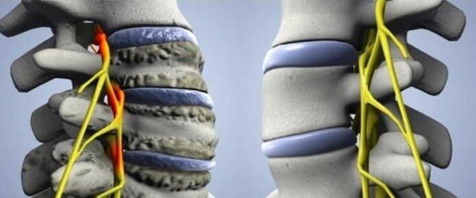 coloana vertebrala sanatoasa si afectata cu artroza