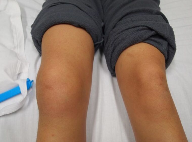 deformarea articulației genunchiului cu artroză
