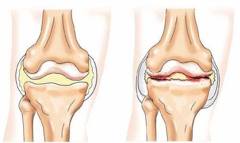 articulația genunchiului sănătoasă și artrotică